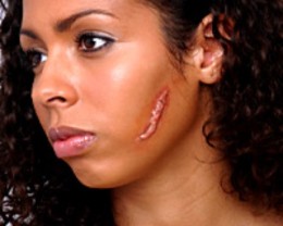 scars